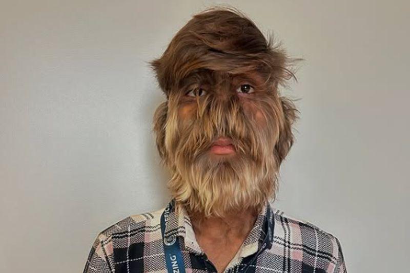 TheRadar Indian teen with hairiest face sets Guinness World Record