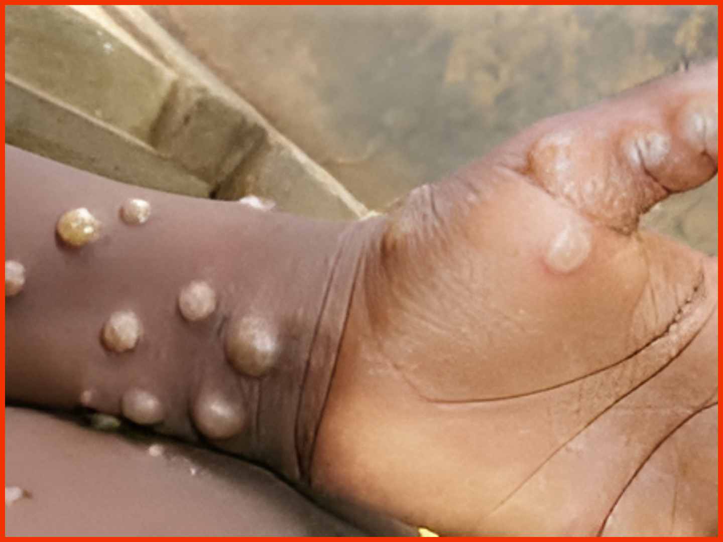 Abia State has confirmed that Monkeypox disease has been detected in Isialangwa Local Government Area of the state